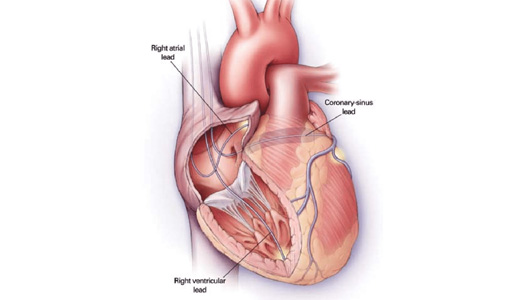La resynchronisation cardiaque (CRT) 