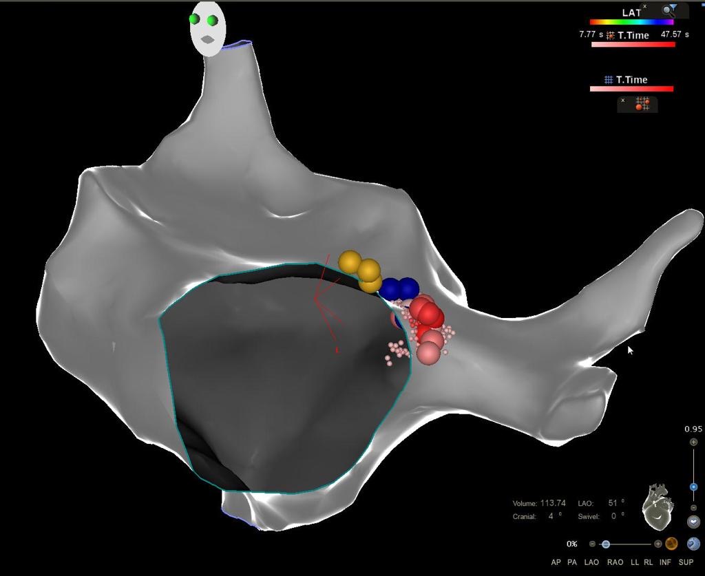 Dr Franck Halimi - Ablation d'une tachycardie par réentrée intra-nodale à l'aide d'un système de cartographie 3D